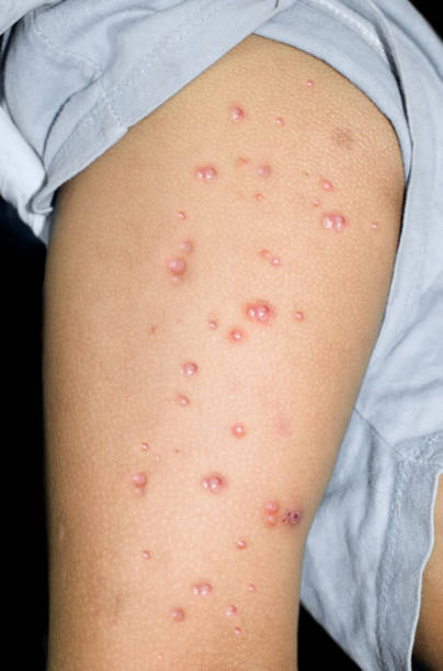 Monkeypox lesions in the thigh of Asian, Burmese Child